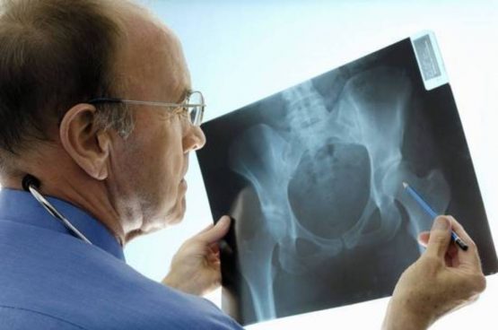 osteoporoza