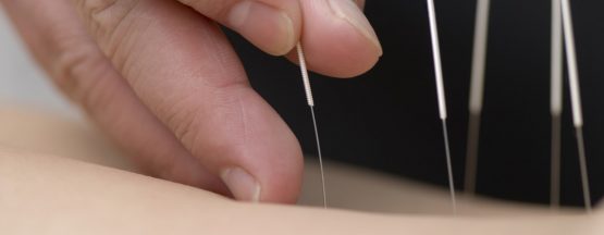 acupunctura