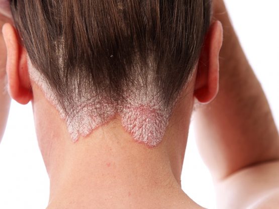 psoriazis